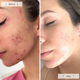 omnilux-clear-led-face-mask-results