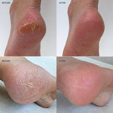 Before and after heel repair treatment showing cracked dry heels transformed to smooth soft skin