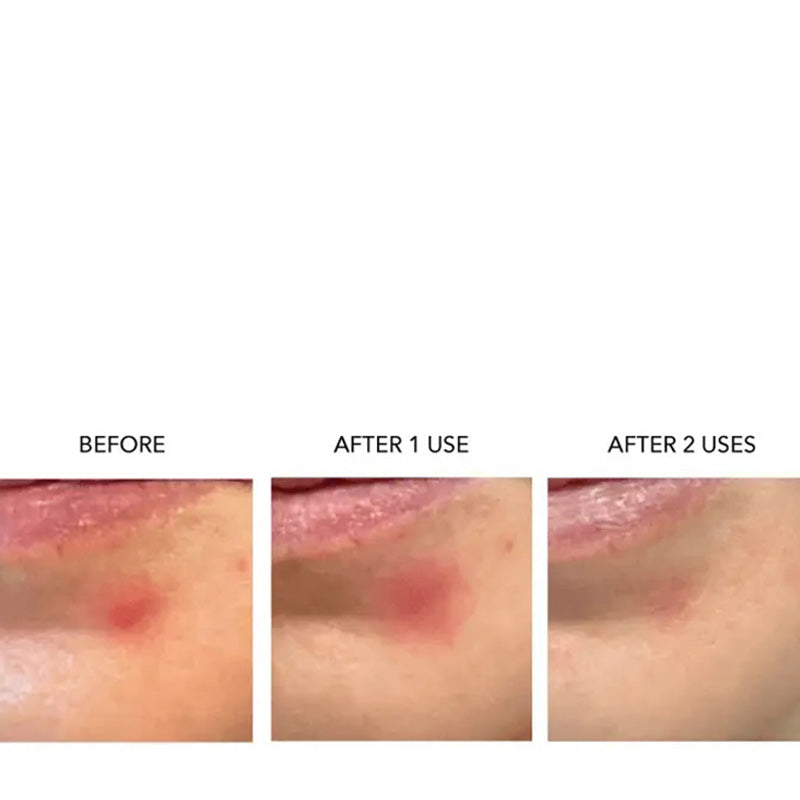 SOON-Magnesium-Hydrocolloid-Acne-Patches-results